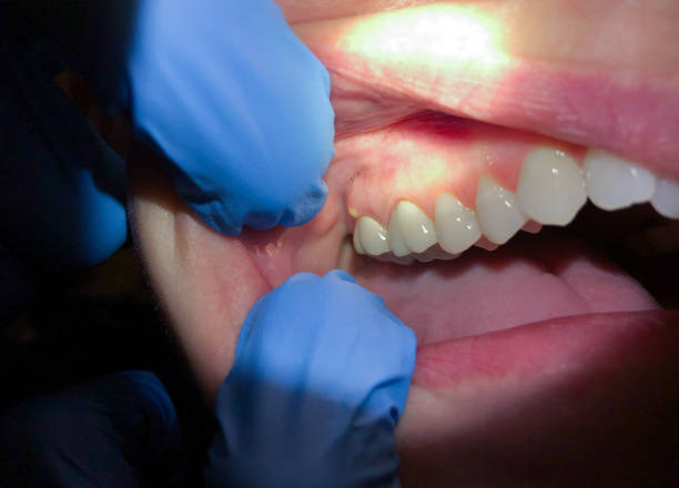 Best Chipped Tooth Repair Near Me  in Carthage, MS
