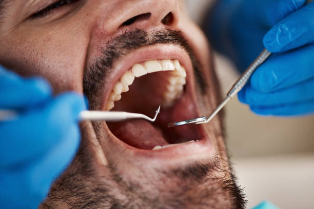 Best Dentist for Tooth Abscess  in Carthage, MS